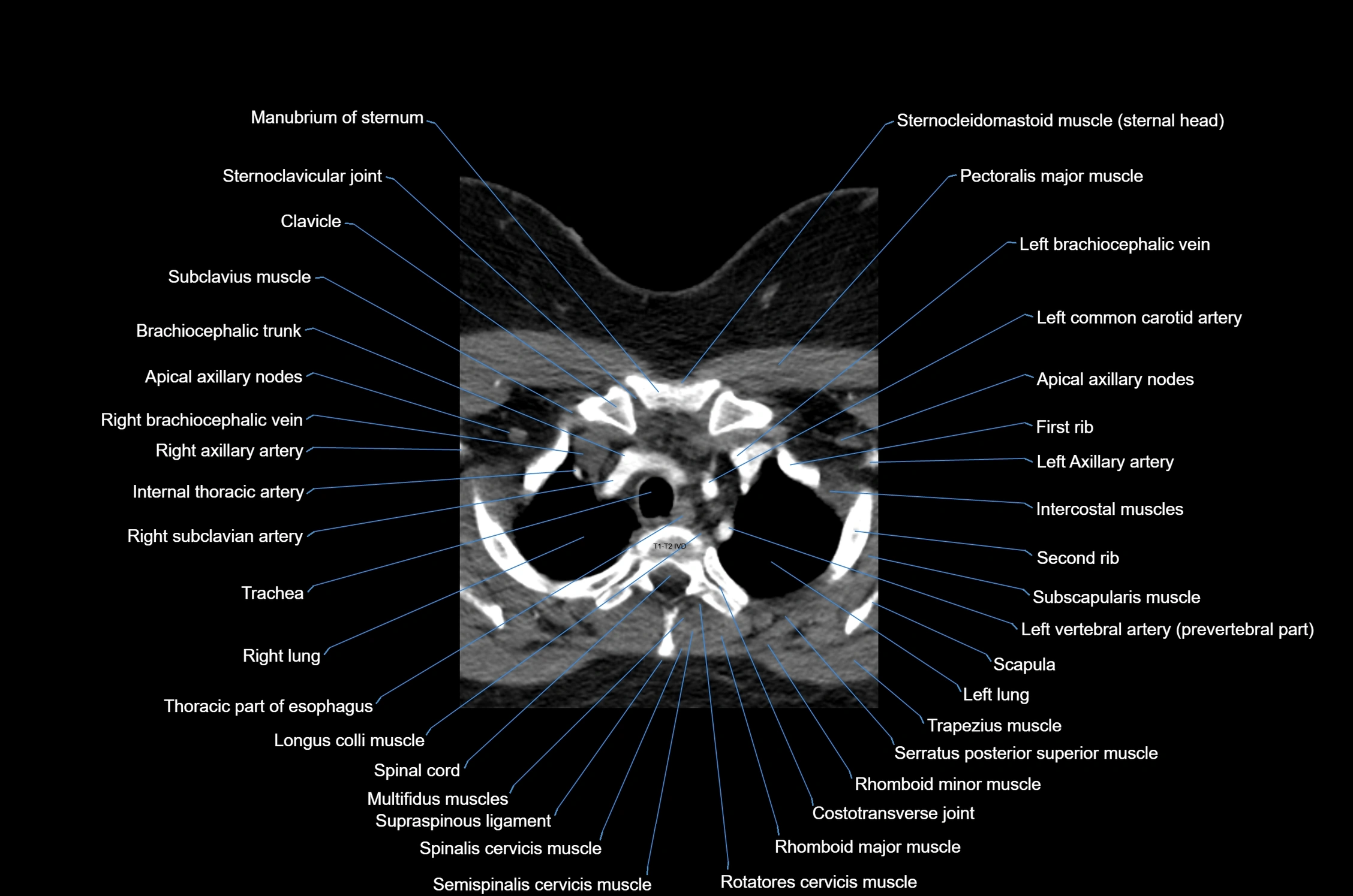 CT Neck axial cross sectional anatomy radiology image-img-00001-00058.webp